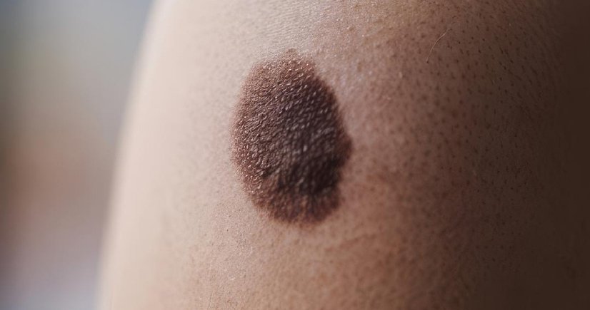 Mole removal treatment in bangalore